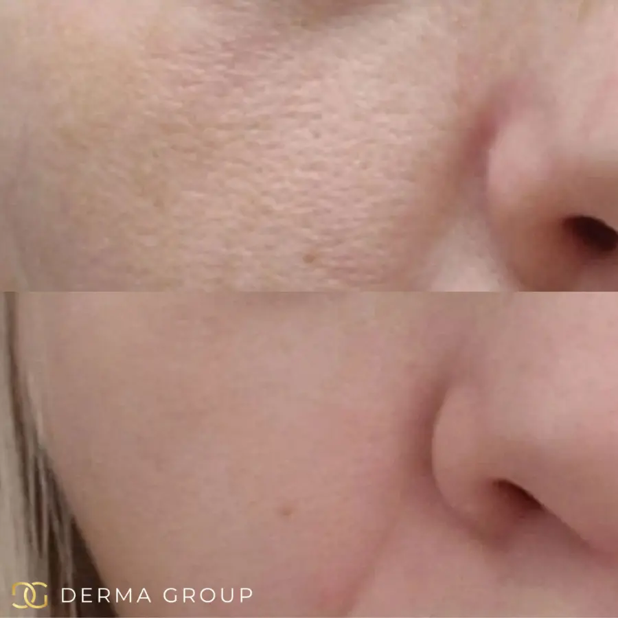 Radiofrequency Microneedling before and after