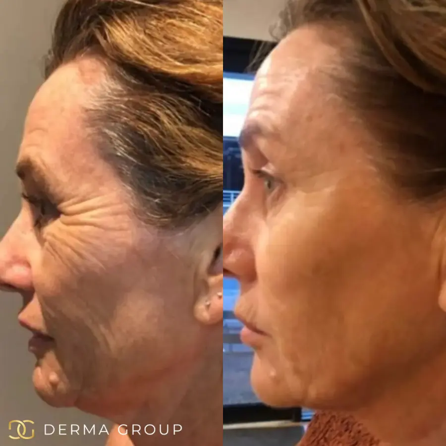 Radiofrequency Microneedling before and after