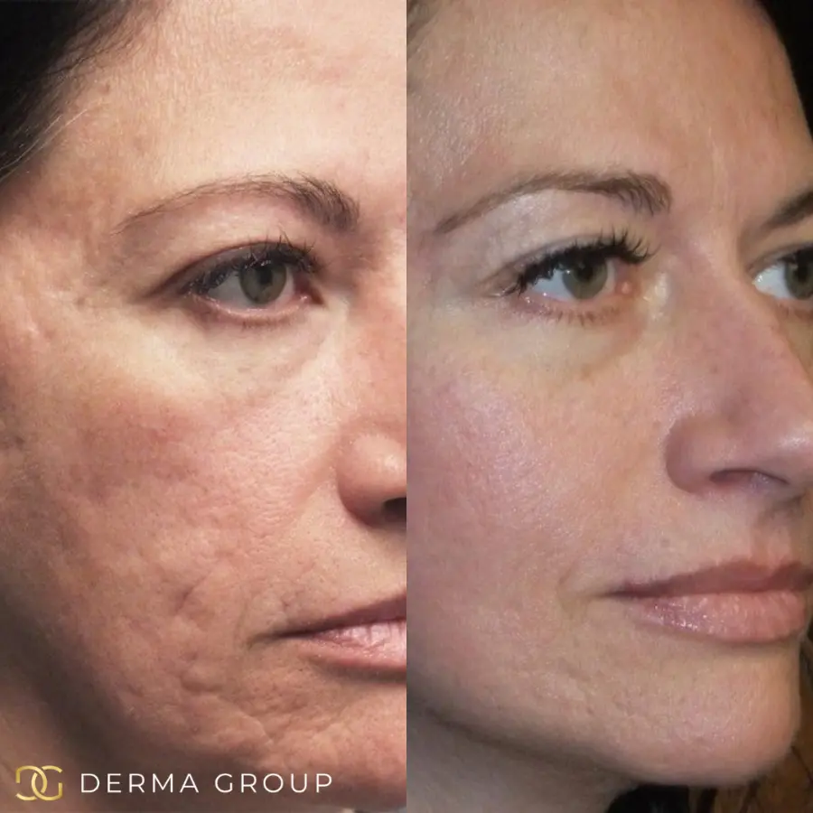 RF Microneedling before and after