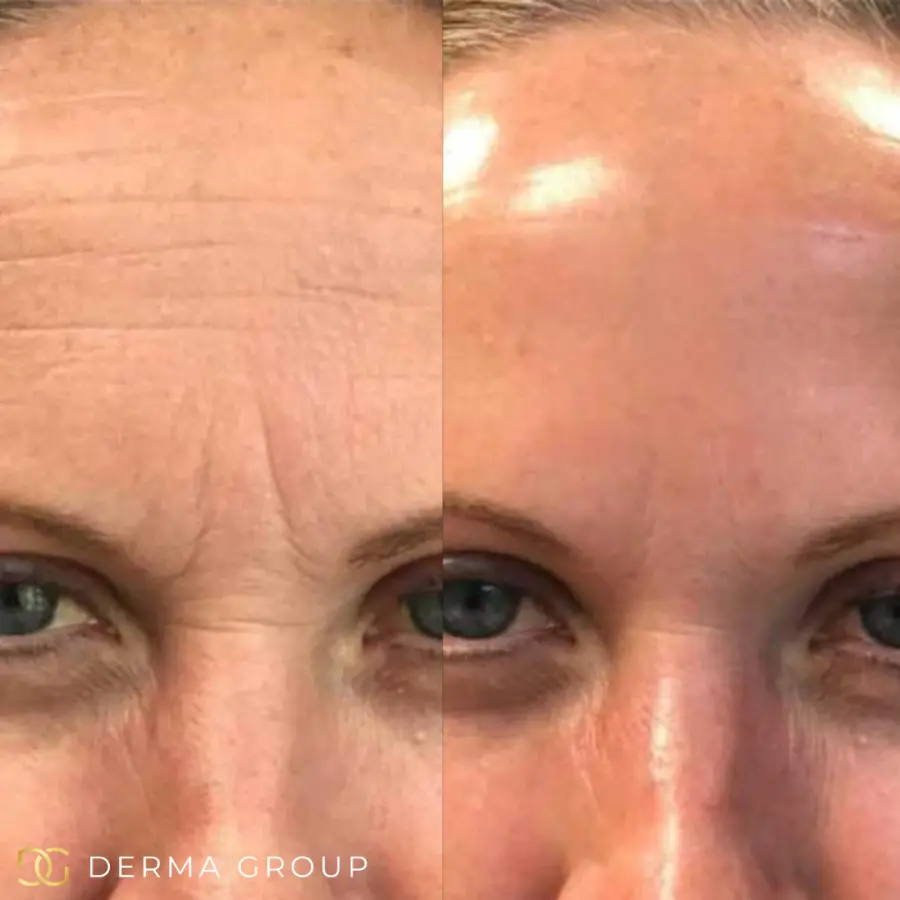 Radiofrequency Microneedling before and after