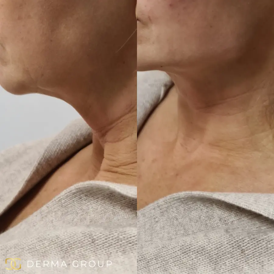 Radiofrequency Microneedling before and after