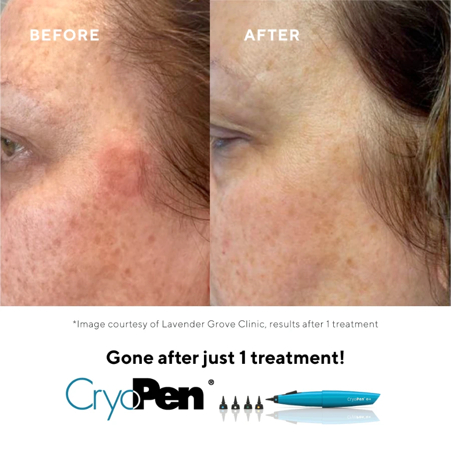 Cryopen before and after pigmentation