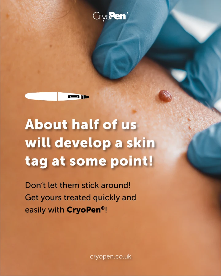 Cryopen skin tag removal